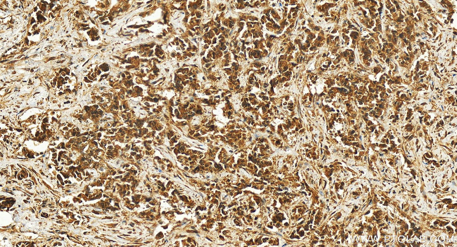 IHC staining of human intrahepatic cholangiocarcinoma using 27279-1-AP