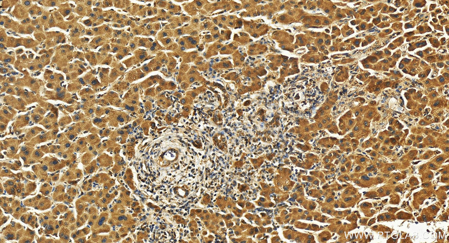 IHC staining of human intrahepatic cholangiocarcinoma using 27279-1-AP