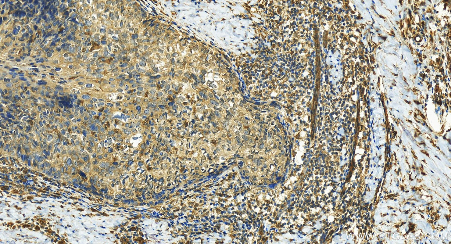 IHC staining of human bowen disease using 15523-1-AP