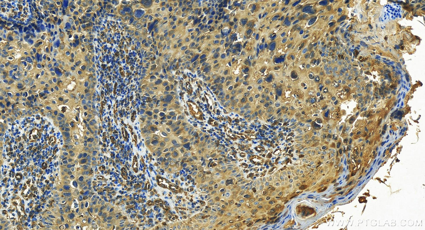 IHC staining of human bowen disease using 15523-1-AP