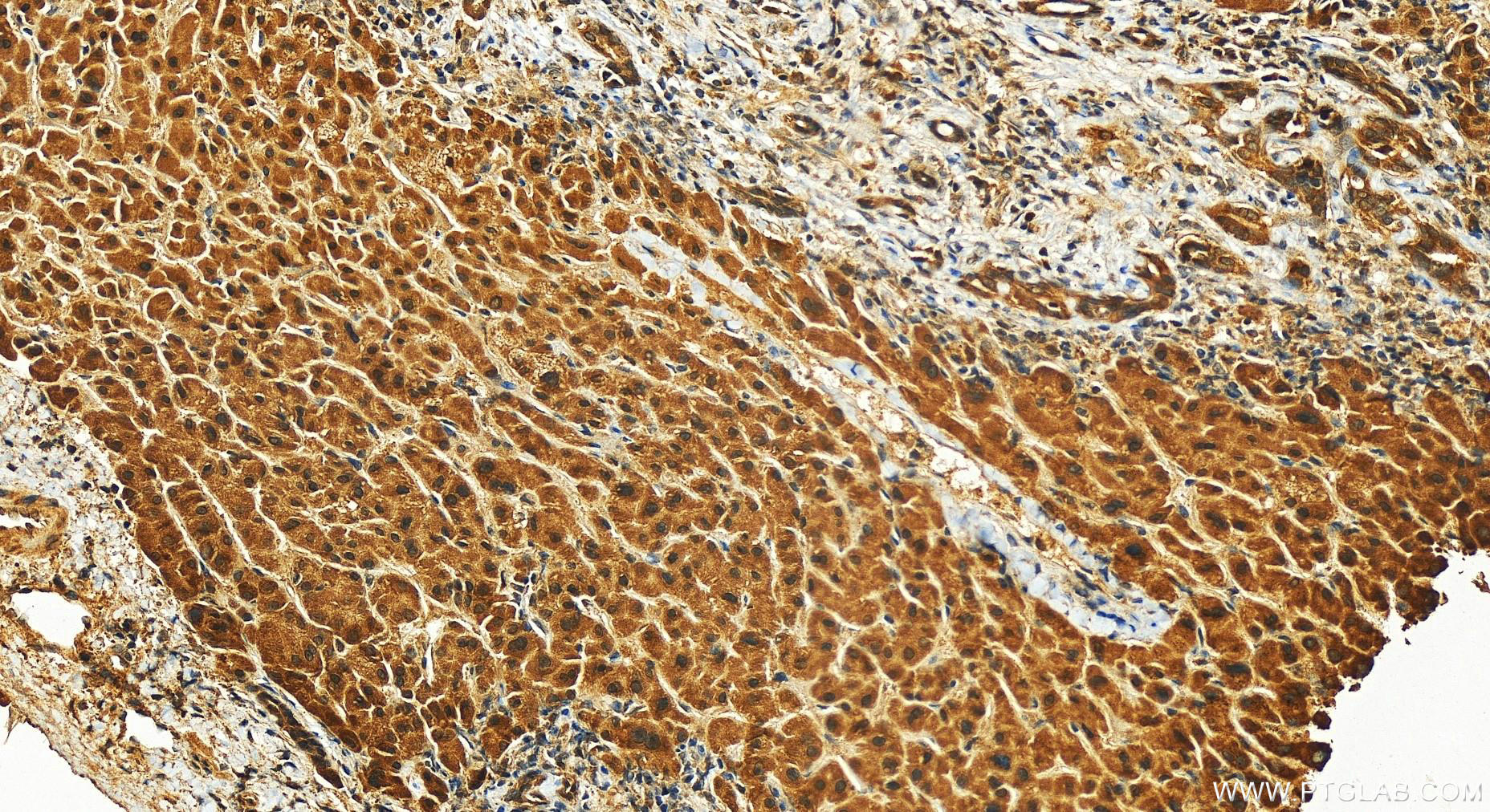 IHC staining of human intrahepatic cholangiocarcinoma using 14806-1-AP