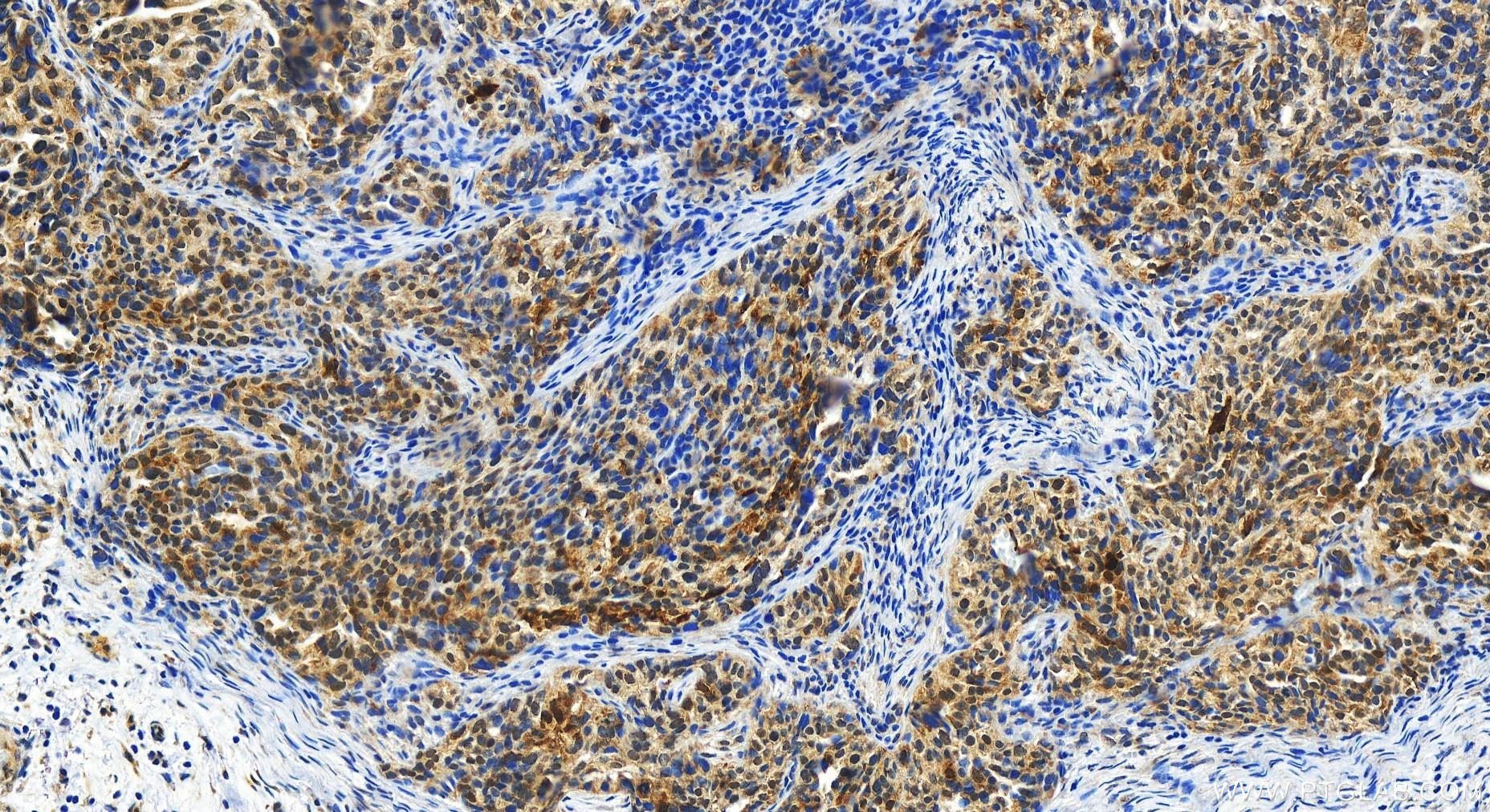 IHC staining of human ovary cancer using 14806-1-AP