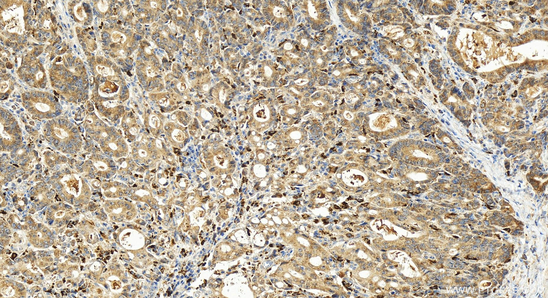 IHC staining of human stomach cancer using 21111-1-AP