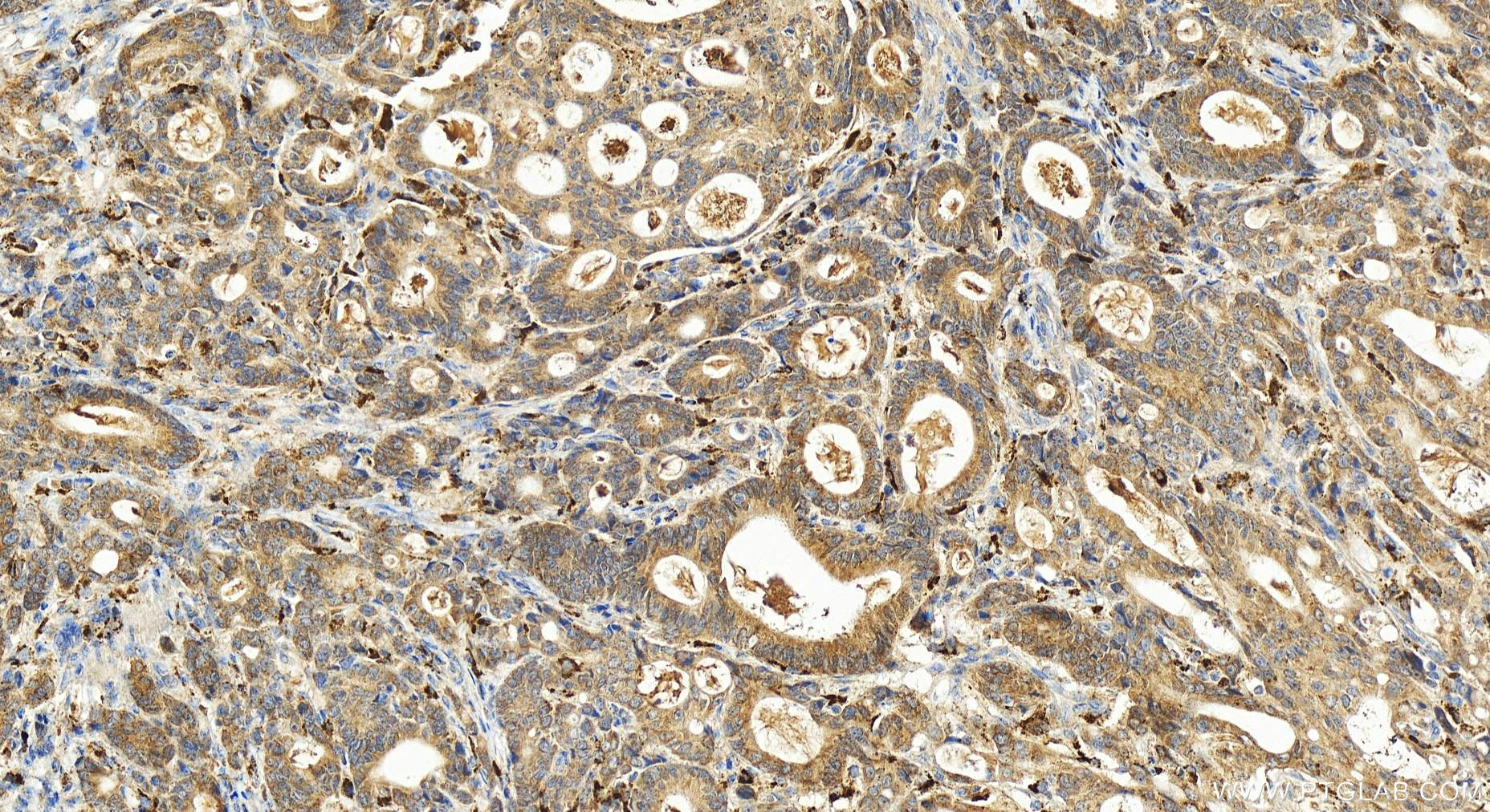 IHC staining of human stomach cancer using 21111-1-AP