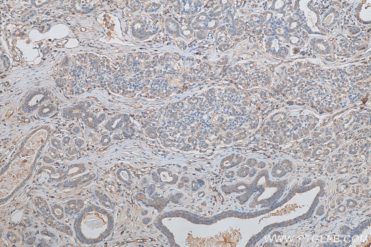 IHC staining of human breast cancer using 23345-1-AP