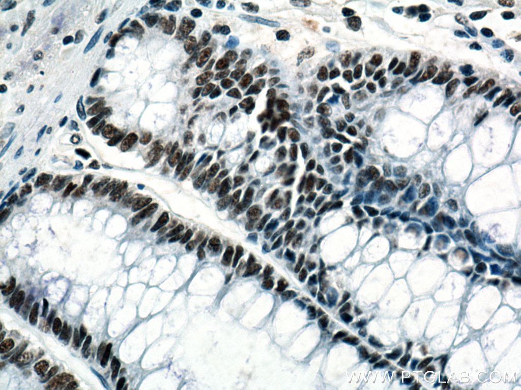 IHC staining of human colon cancer using 67037-1-Ig (same clone as 67037-1-PBS)