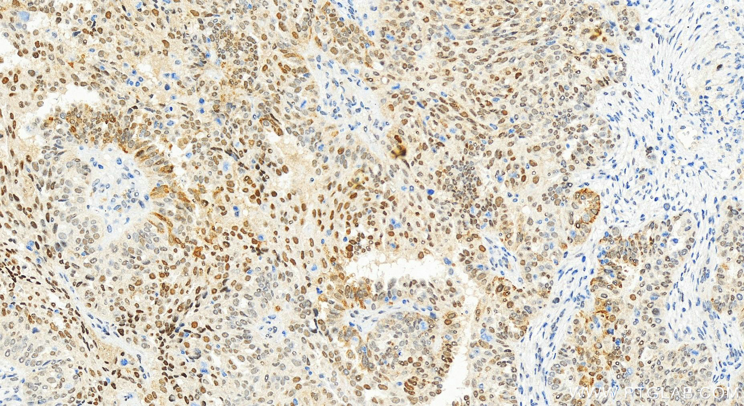 IHC staining of human ovarian  cancer using 83571-2-RR