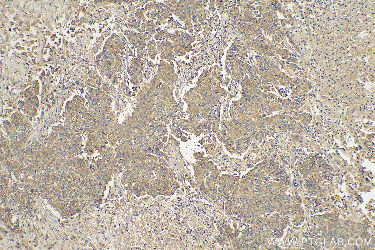 IHC staining of human stomach cancer using 23443-1-AP