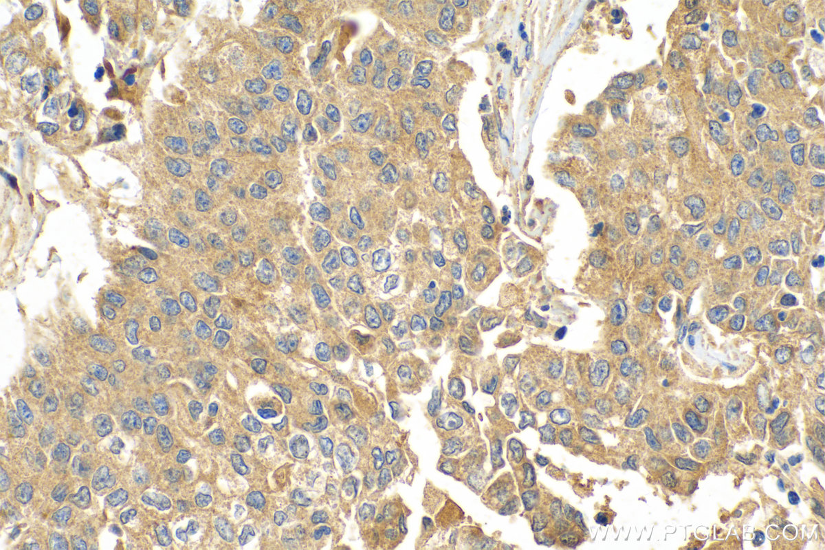 IHC staining of human stomach cancer using 23443-1-AP