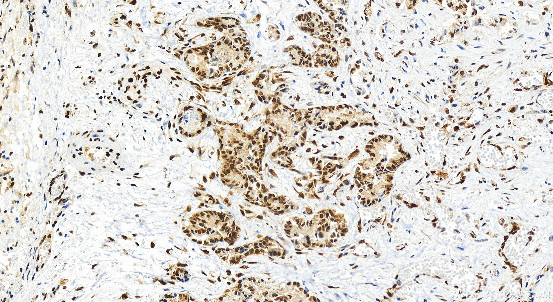 IHC staining of human intrahepatic cholangiocarcinoma using 82931-5-RR