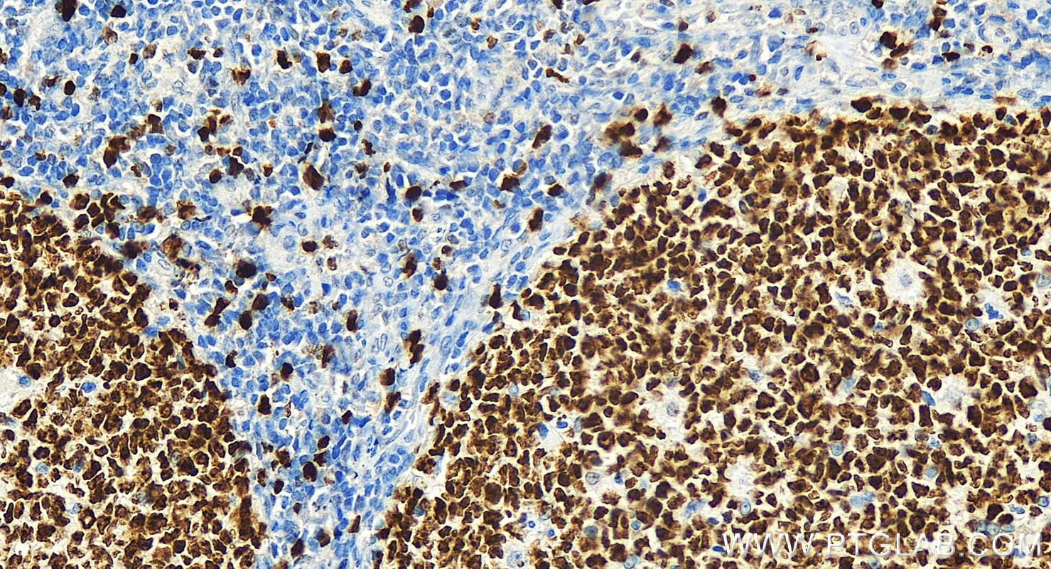 IHC staining of human tonsillitis using 27309-1-AP