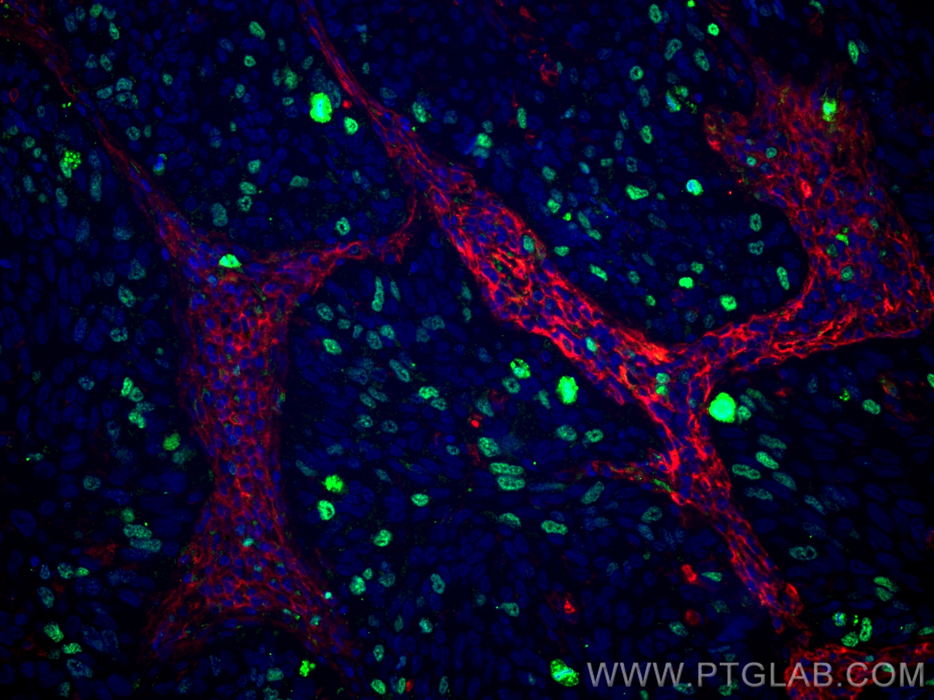 IF Staining of human lung cancer using 84192-3-RR (same clone as 84192-3-PBS)