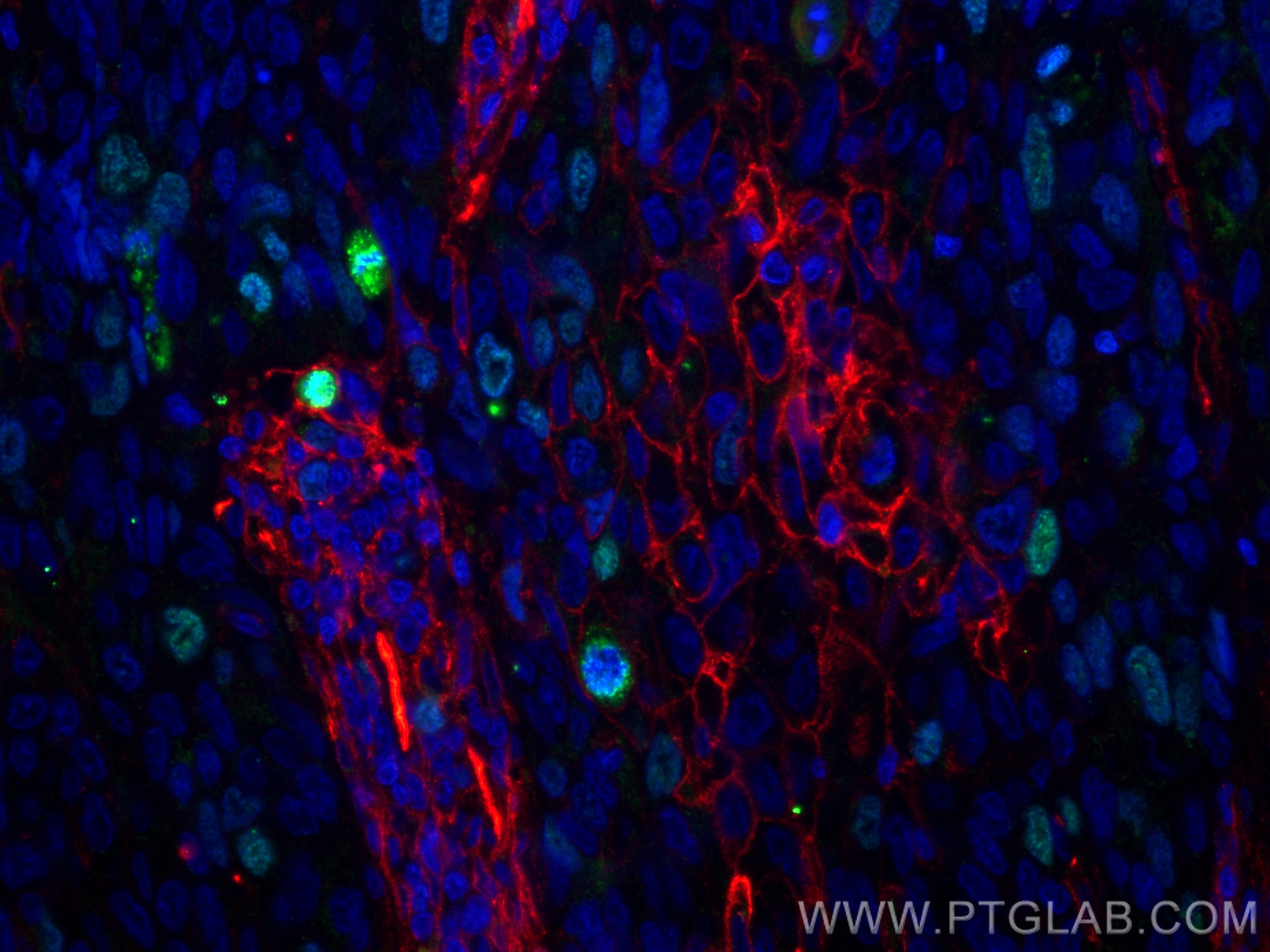 IF Staining of human lung cancer using 84192-3-RR (same clone as 84192-3-PBS)