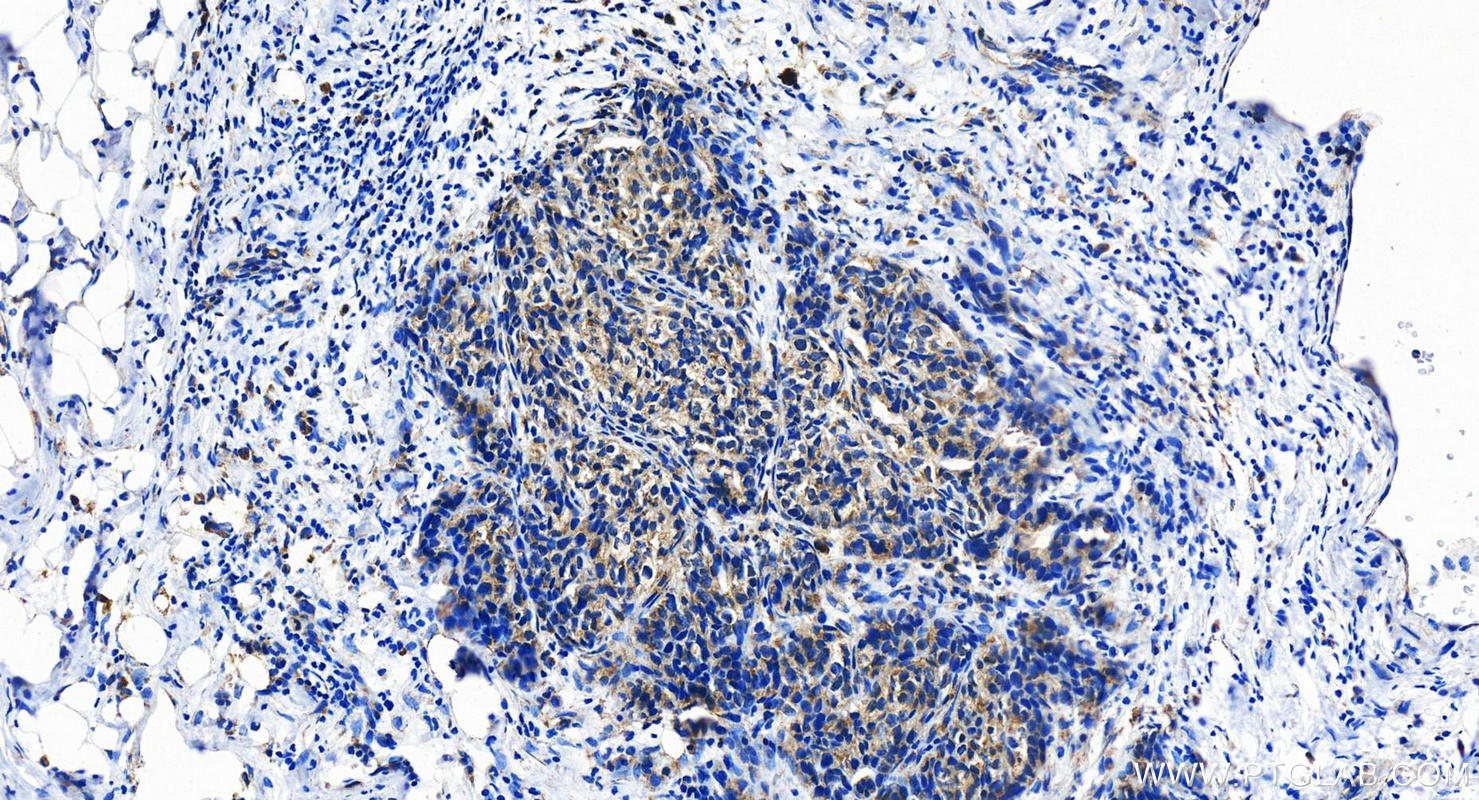 IHC staining of human ovary cancer using 21478-1-AP