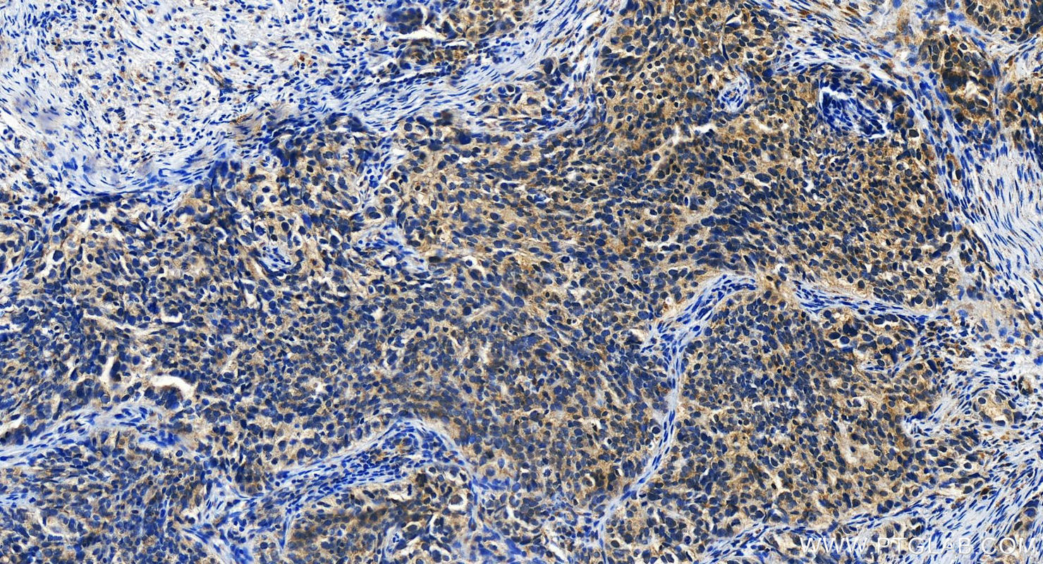 IHC staining of human ovary cancer using 21478-1-AP