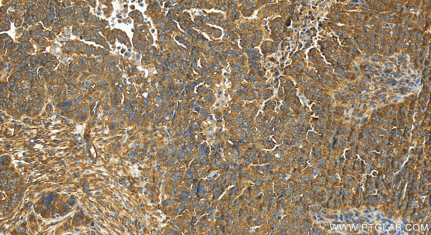 IHC staining of human ovarian  cancer using 82718-3-RR (same clone as 82718-3-PBS)