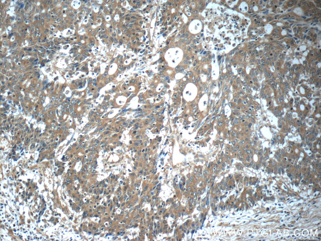 IHC staining of human colon cancer using 25721-1-AP