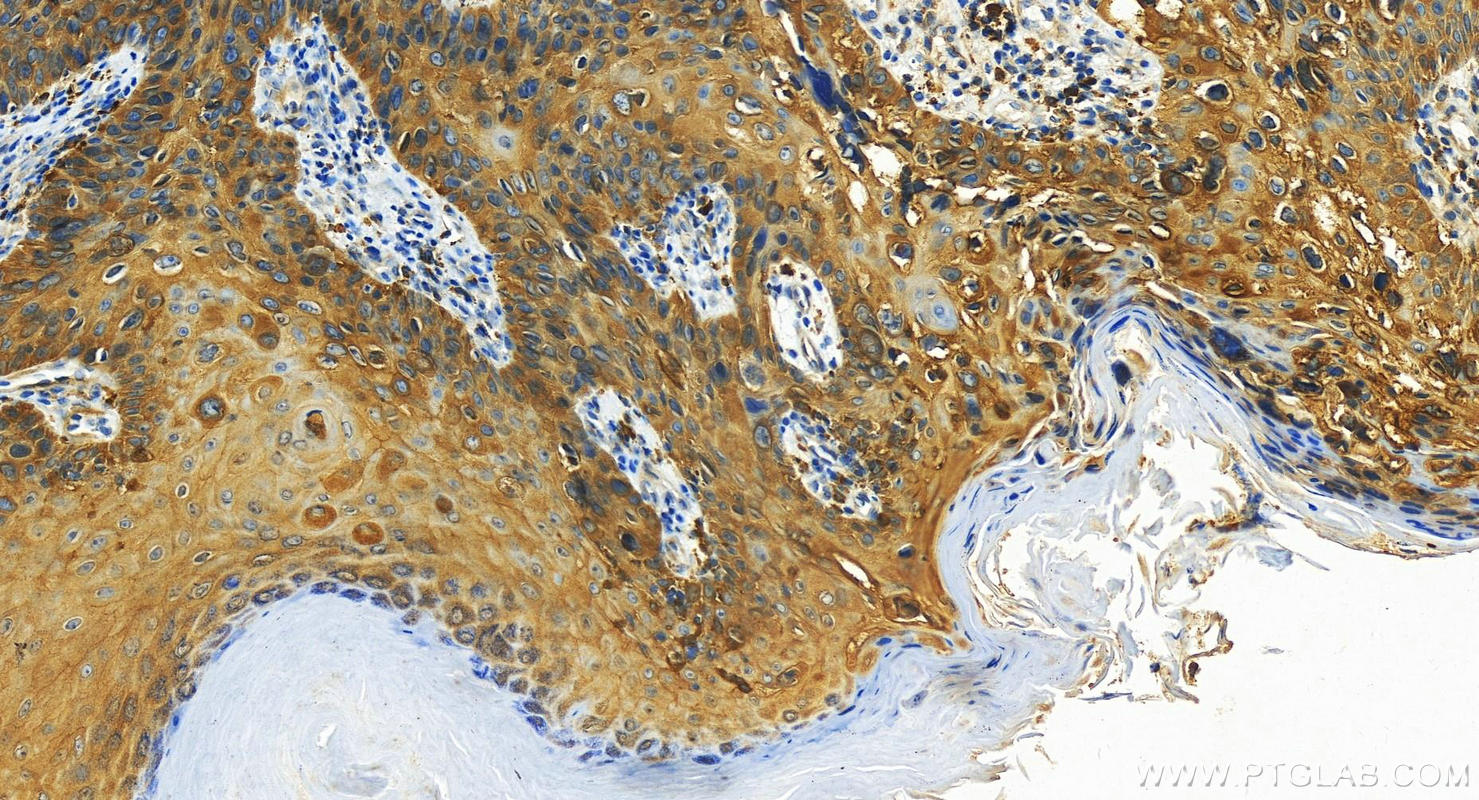 IHC staining of human bowen disease using 24383-1-AP