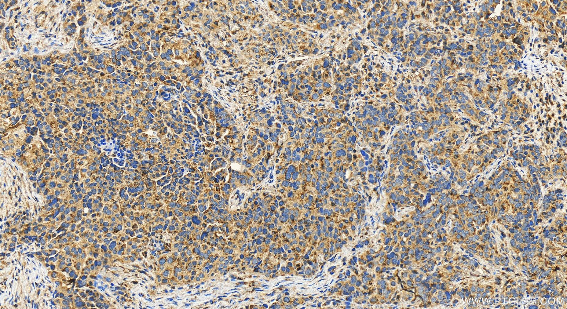 IHC staining of human ovary cancer using 27886-1-AP