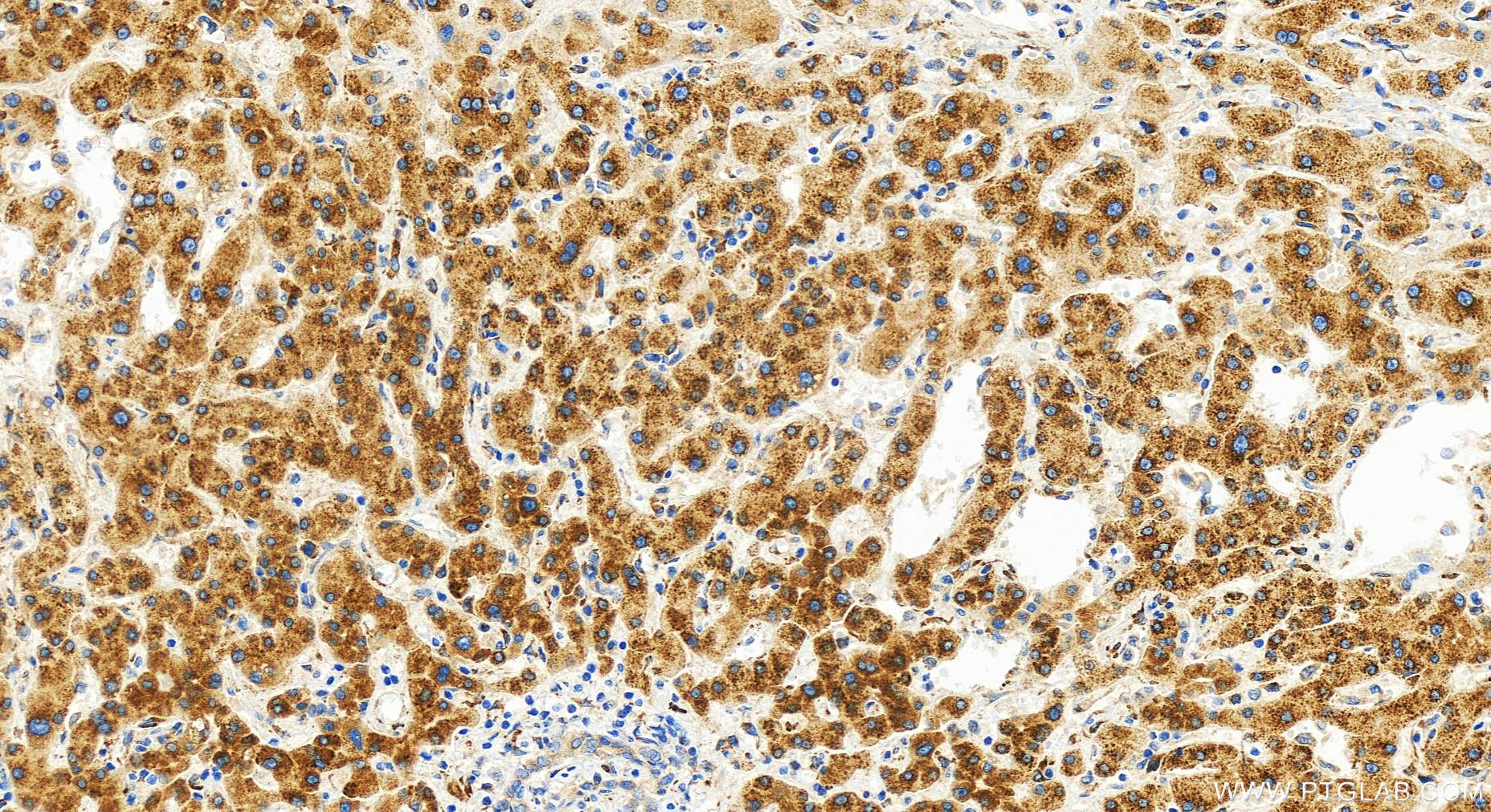 IHC staining of human intrahepatic cholangiocarcinoma using 82903-1-RR