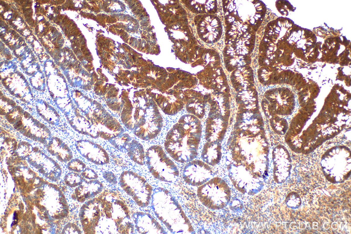 IHC staining of human colon  cancer using 19245-1-AP