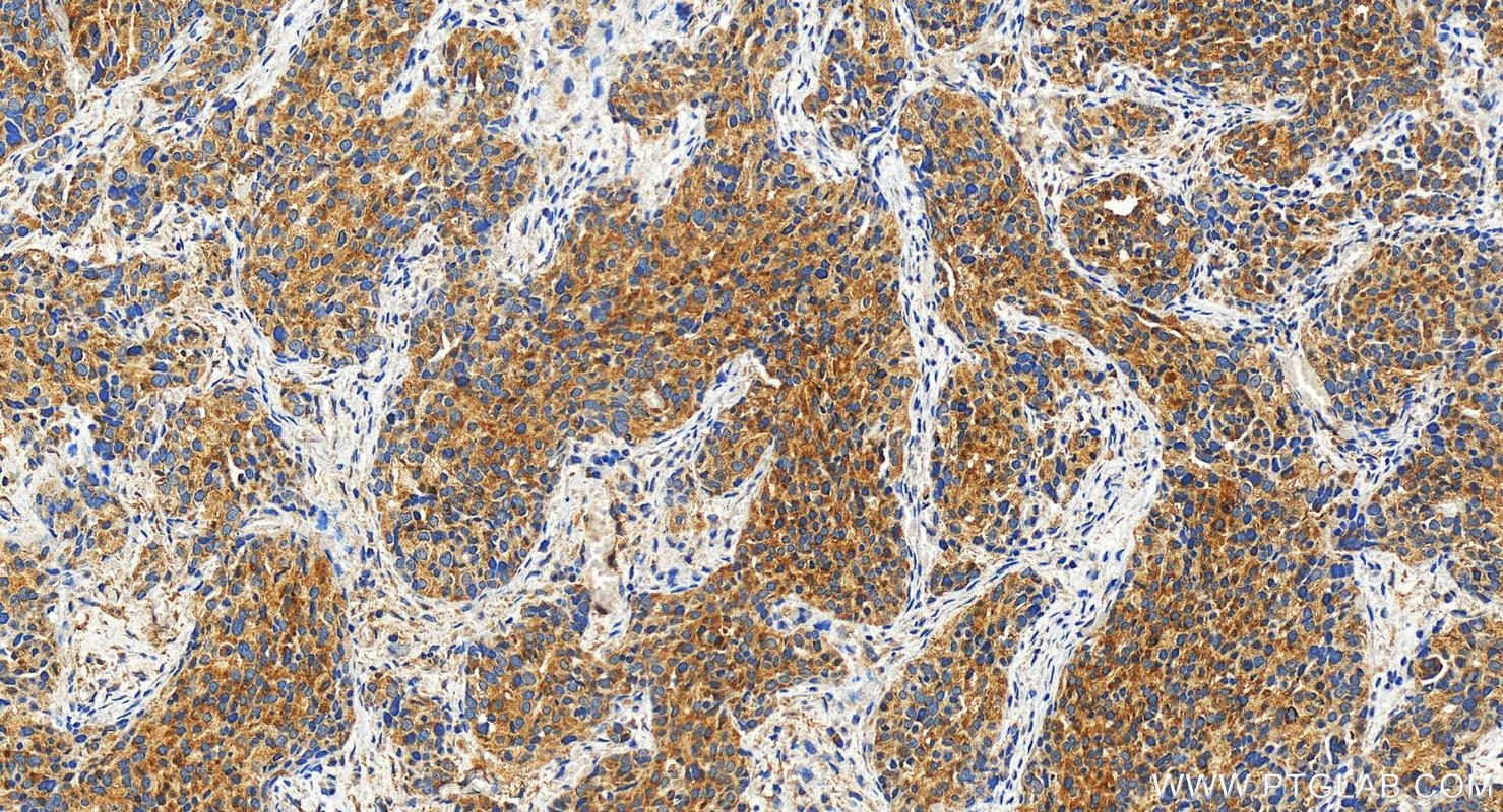 IHC staining of human ovary cancer using 27276-1-AP