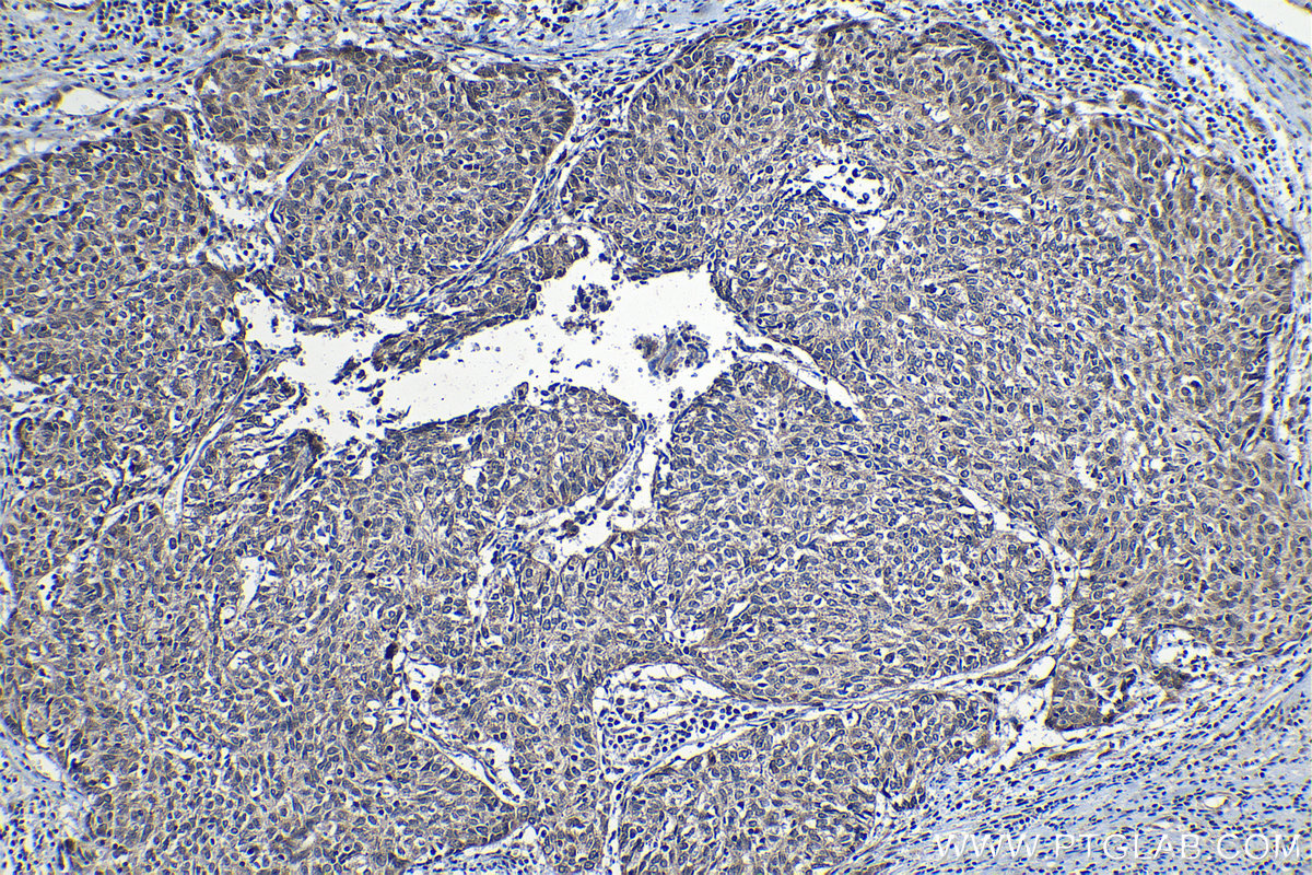 IHC staining of human cervical cancer using 13403-1-AP