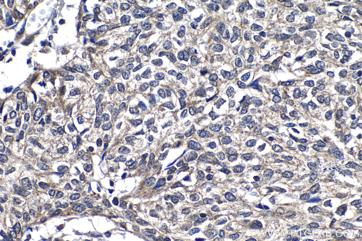 IHC staining of human cervical cancer using 13403-1-AP