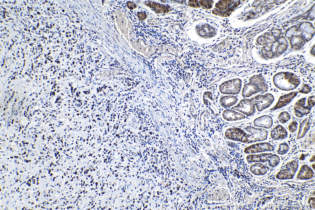 IHC staining of human stomach cancer using 13403-1-AP