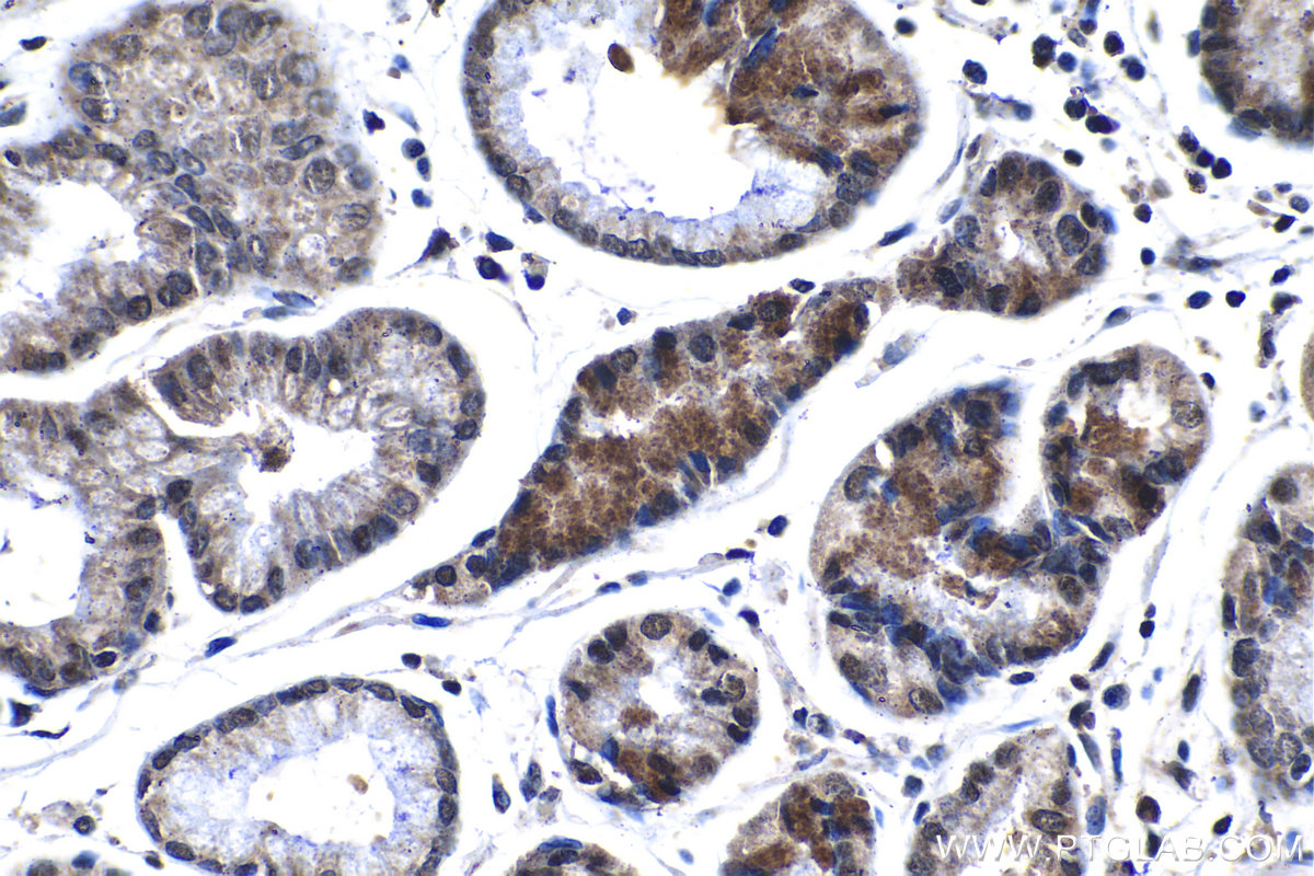 IHC staining of human stomach cancer using 13403-1-AP