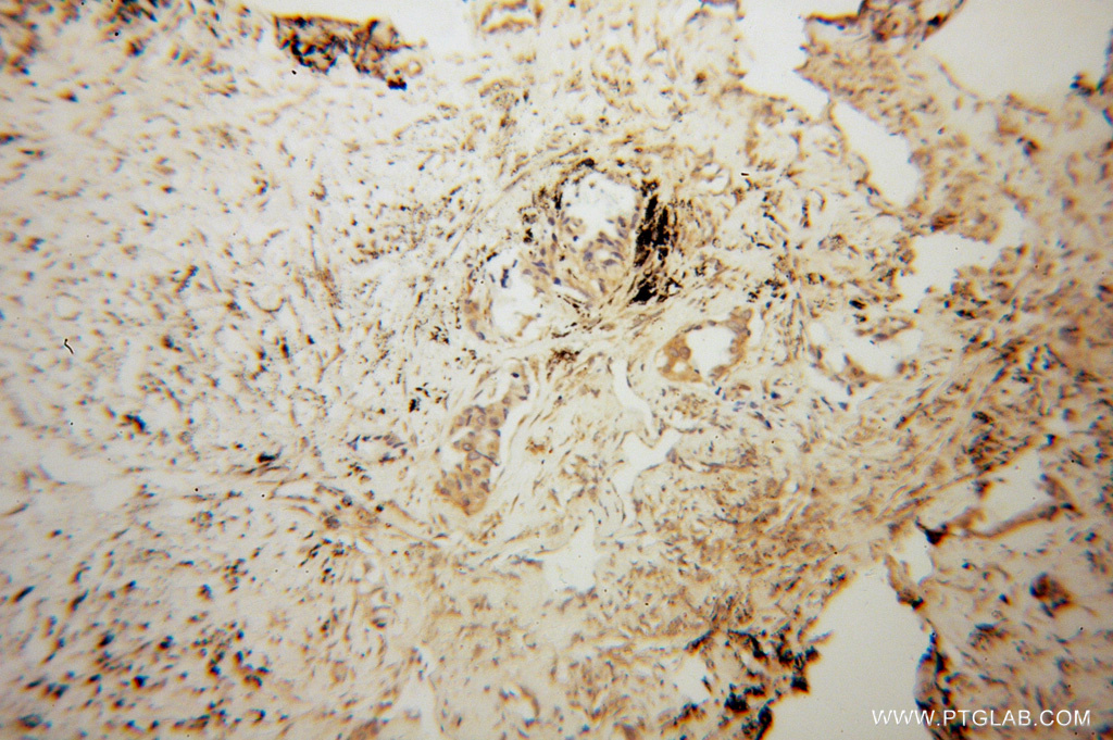 IHC staining of human lung cancer using 14344-1-AP