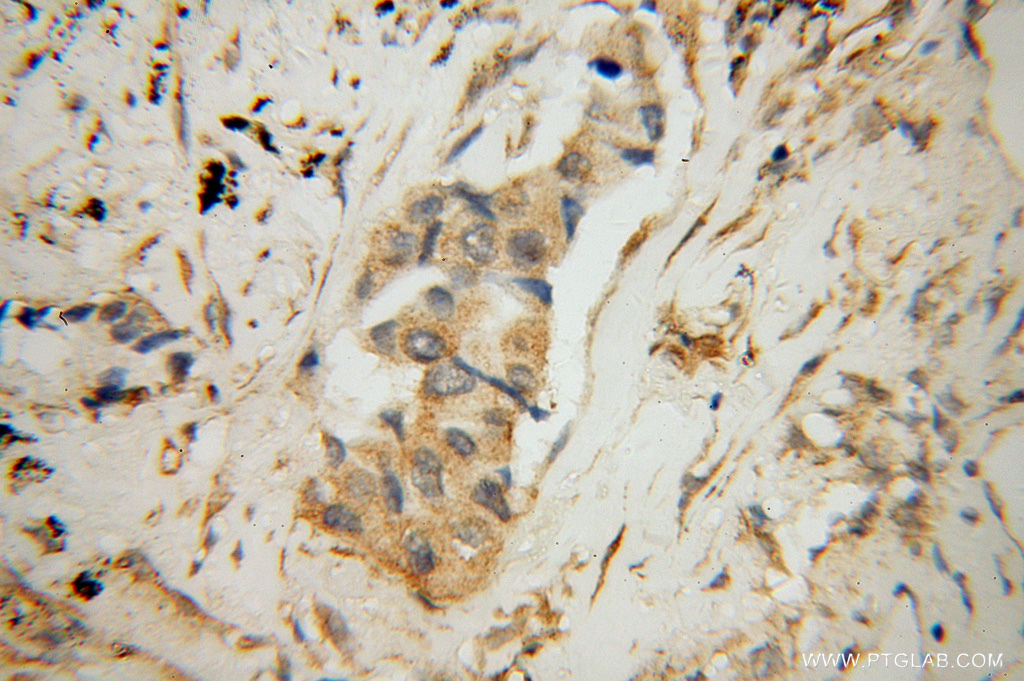 IHC staining of human lung cancer using 14344-1-AP