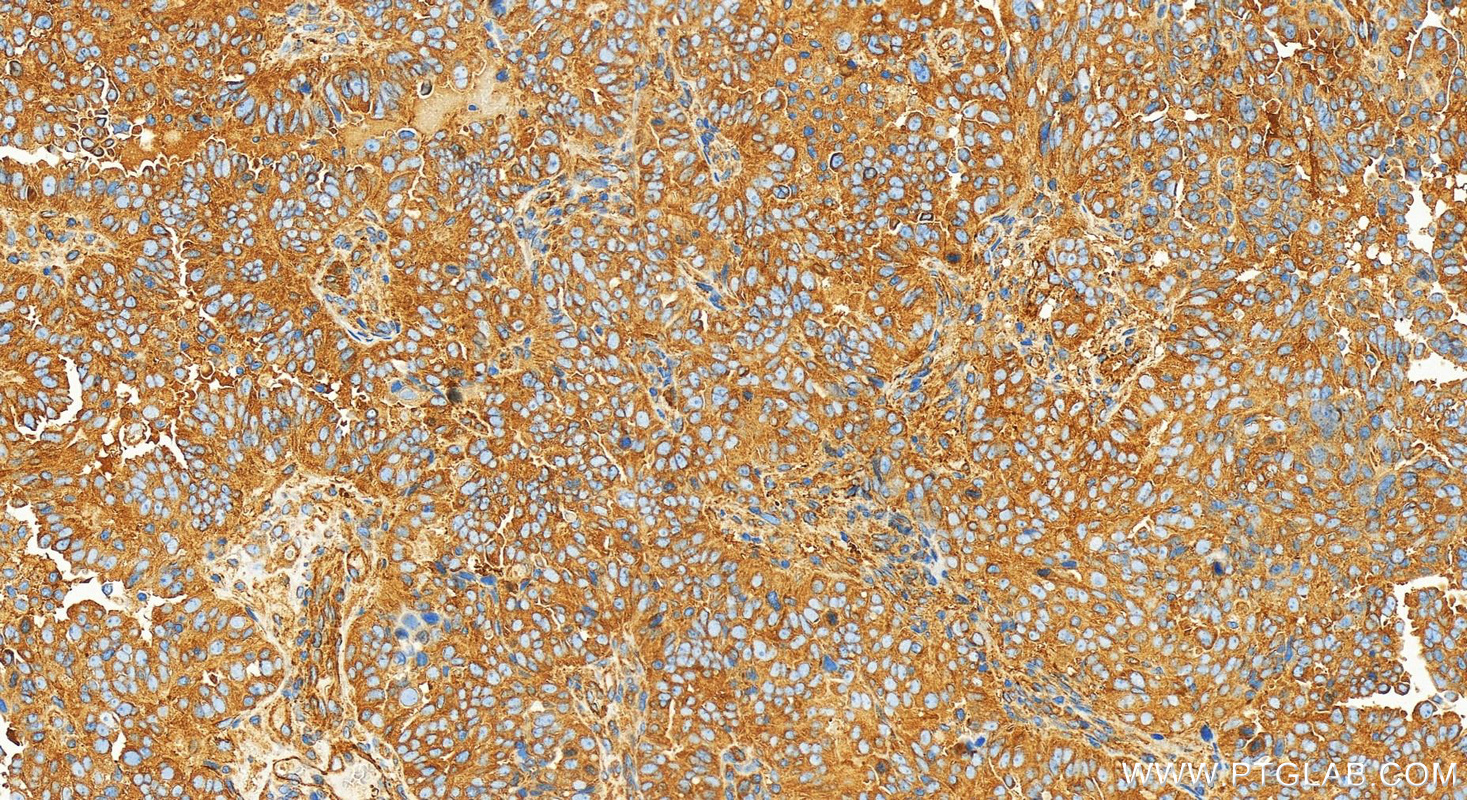 IHC staining of human ovarian  cancer using 82485-1-RR