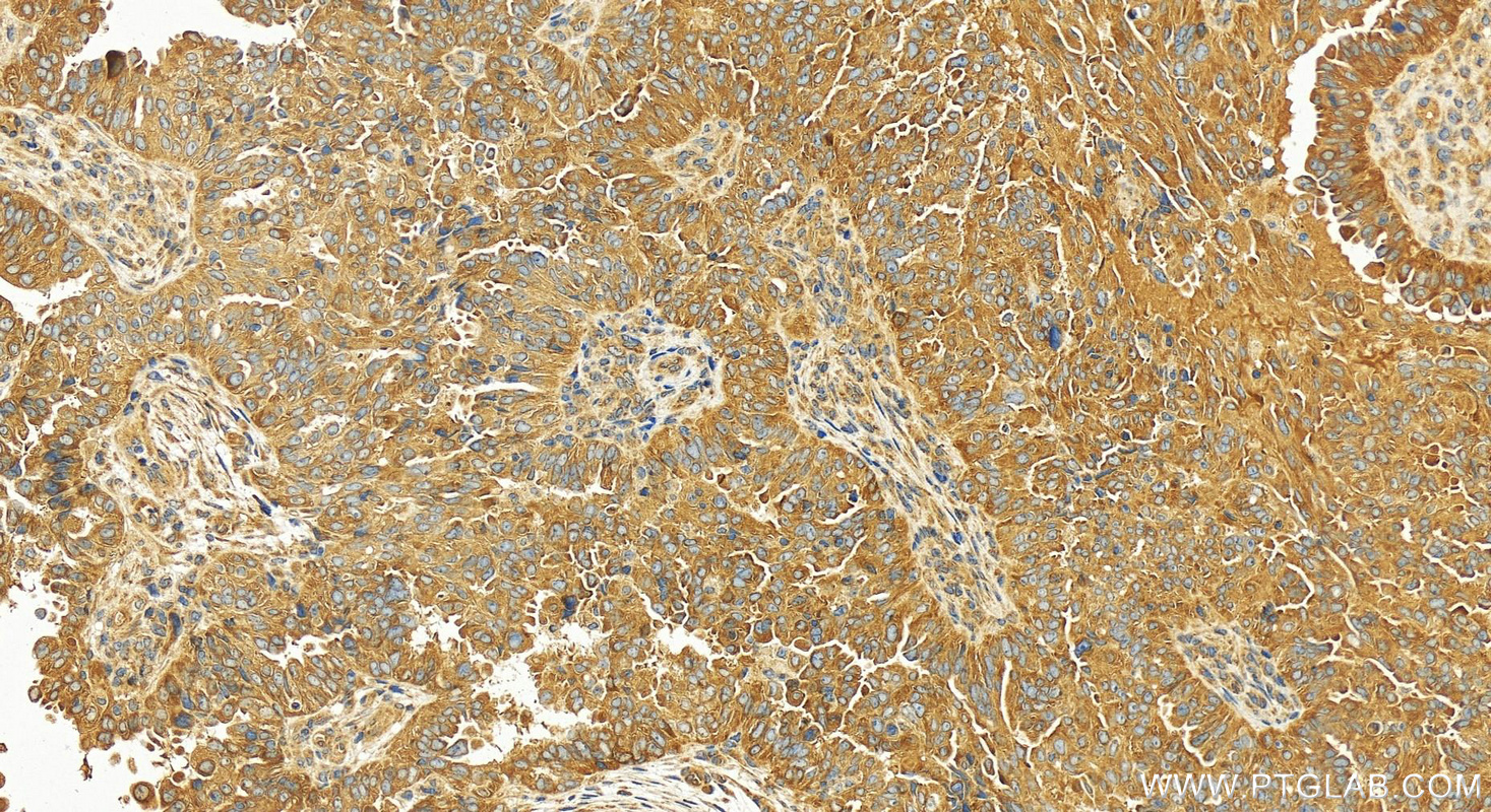 IHC staining of human ovary cancer using 12700-1-AP