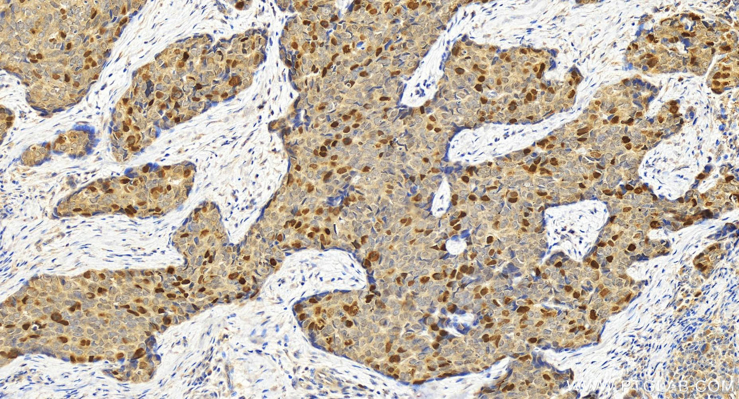 IHC staining of human bowen disease using 20790-1-AP