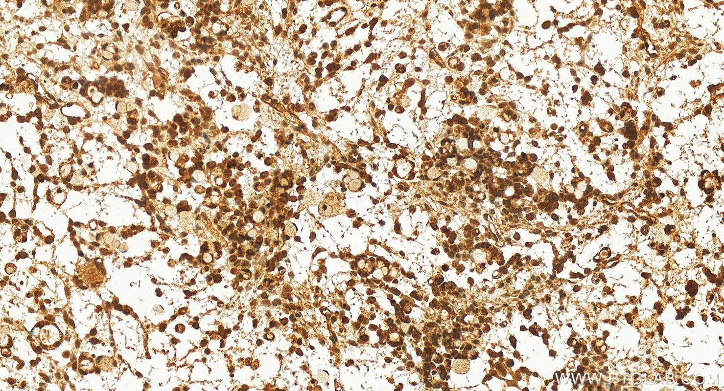 IHC staining of human ovary cancer using 12313-1-AP