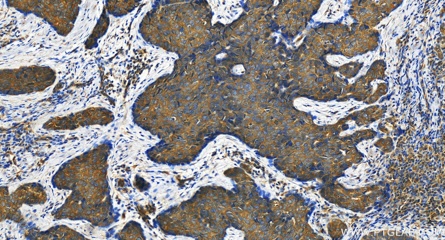 IHC staining of human bowen disease using 19028-1-AP