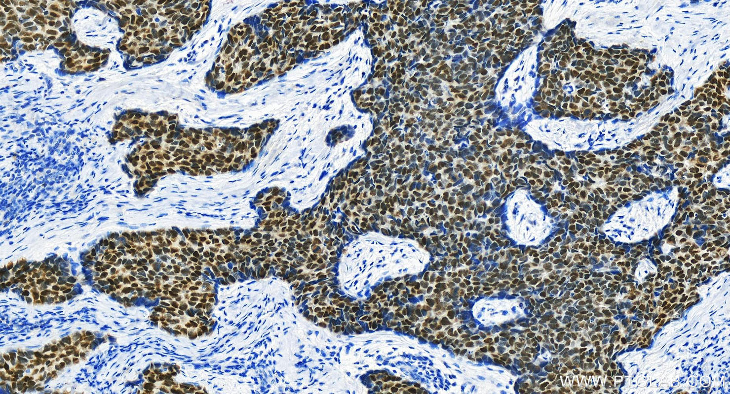 IHC staining of human bowen disease using 21017-1-AP