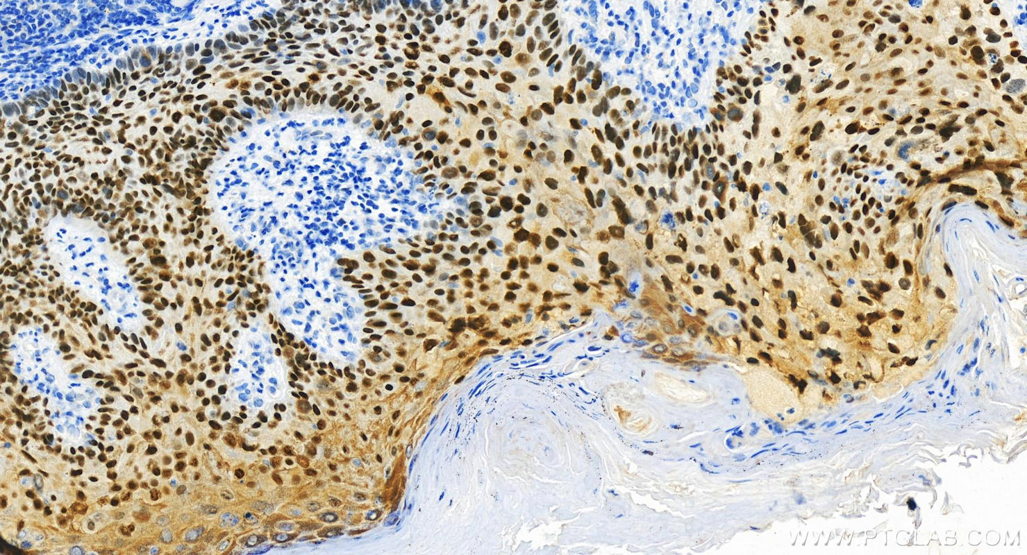 IHC staining of human bowen disease using 21017-1-AP