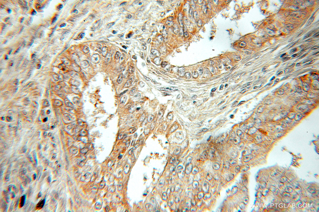 IHC staining of human ovary tumor using 51131-1-AP