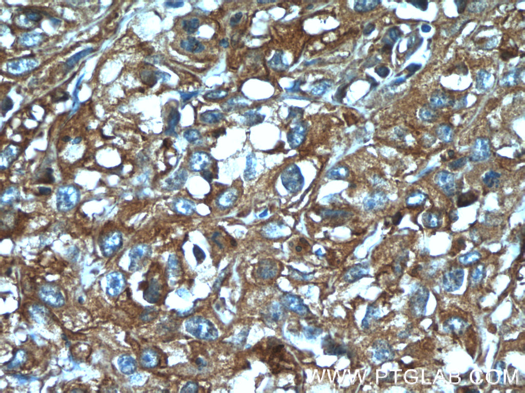 IHC staining of human cervical cancer using 14849-1-AP