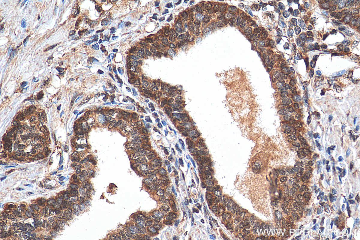 IHC staining of human prostate cancer using 25066-1-AP