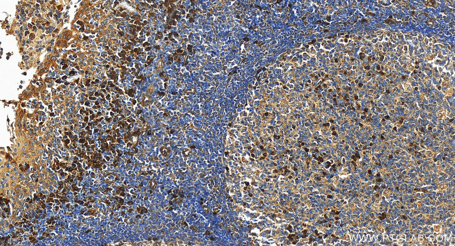 IHC staining of human tonsillitis using 16951-1-AP