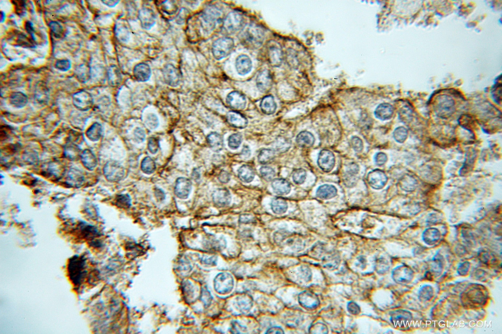 IHC staining of human prostate cancer using 10812-1-AP