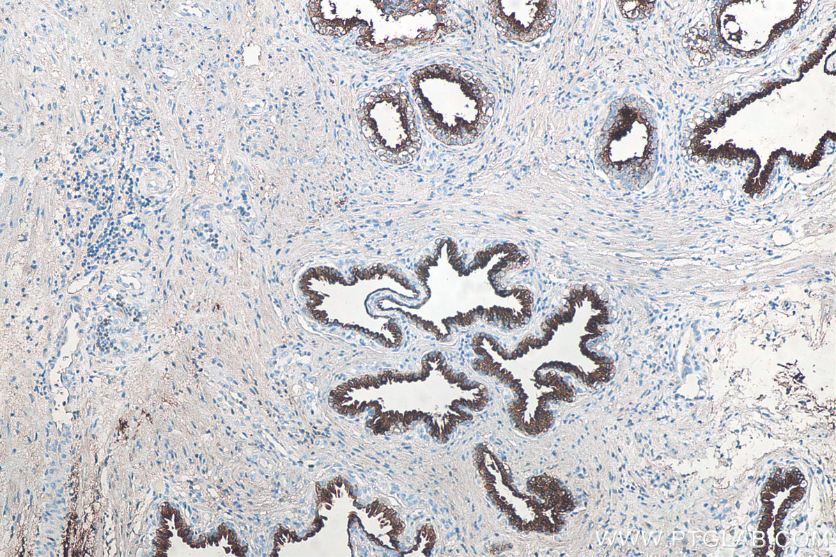 IHC staining of human prostate cancer using 60338-1-Ig (same clone as 60338-1-PBS)