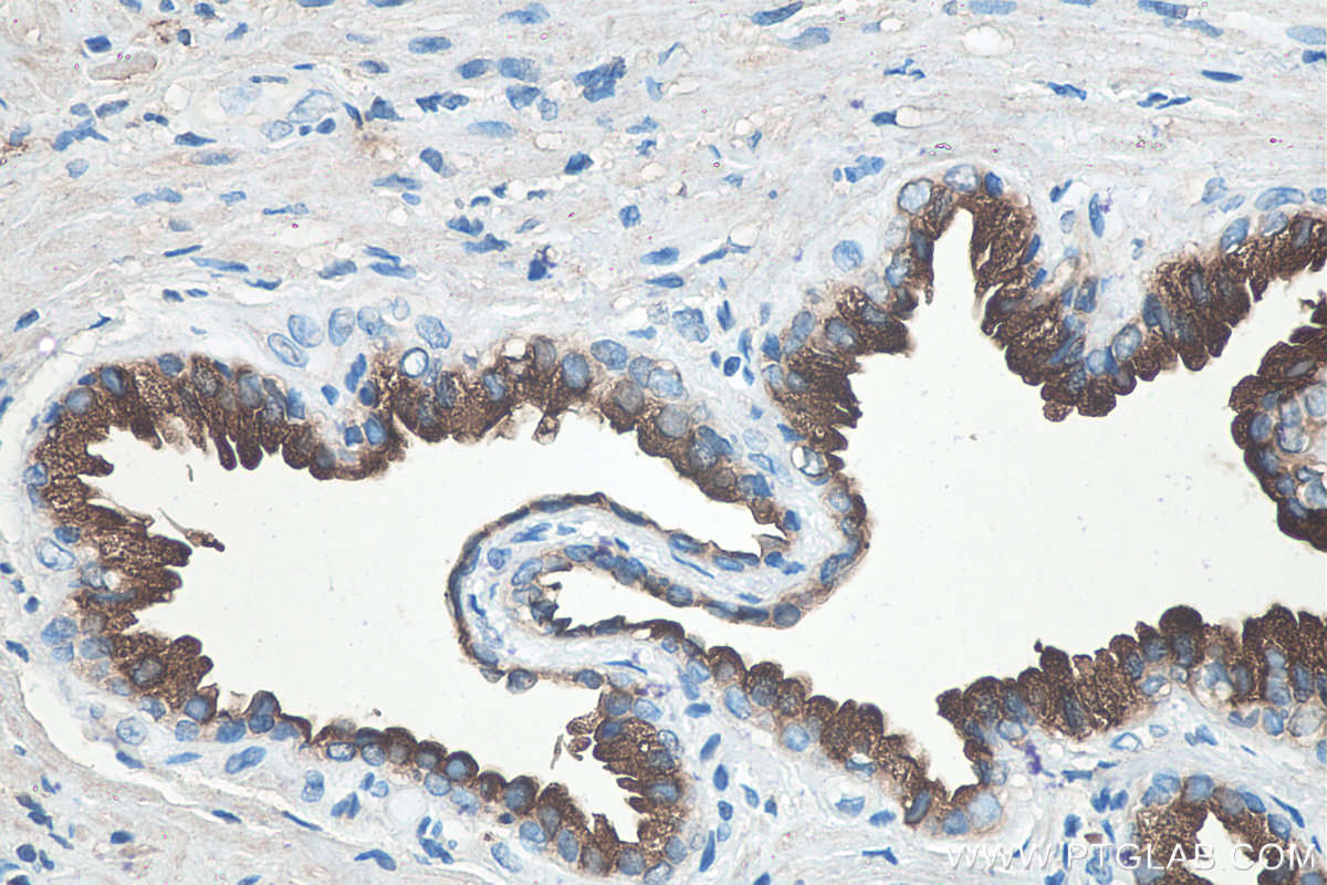 IHC staining of human prostate cancer using 60338-1-Ig (same clone as 60338-1-PBS)