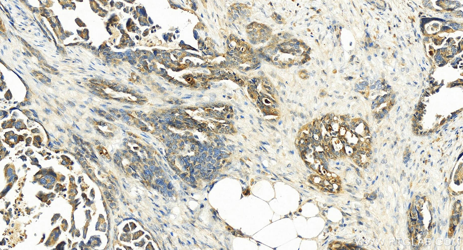 IHC staining of human ovary cancer using 14232-1-AP (same clone as 14232-1-PBS)