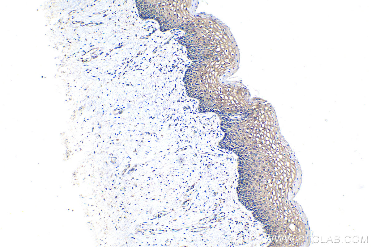 IHC staining of human cervical cancer using 68247-1-Ig