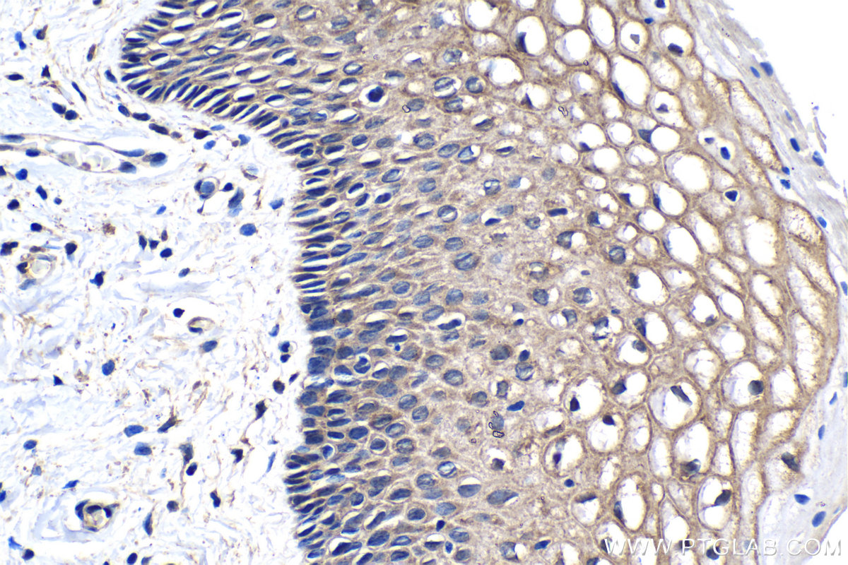 IHC staining of human cervical cancer using 68247-1-Ig