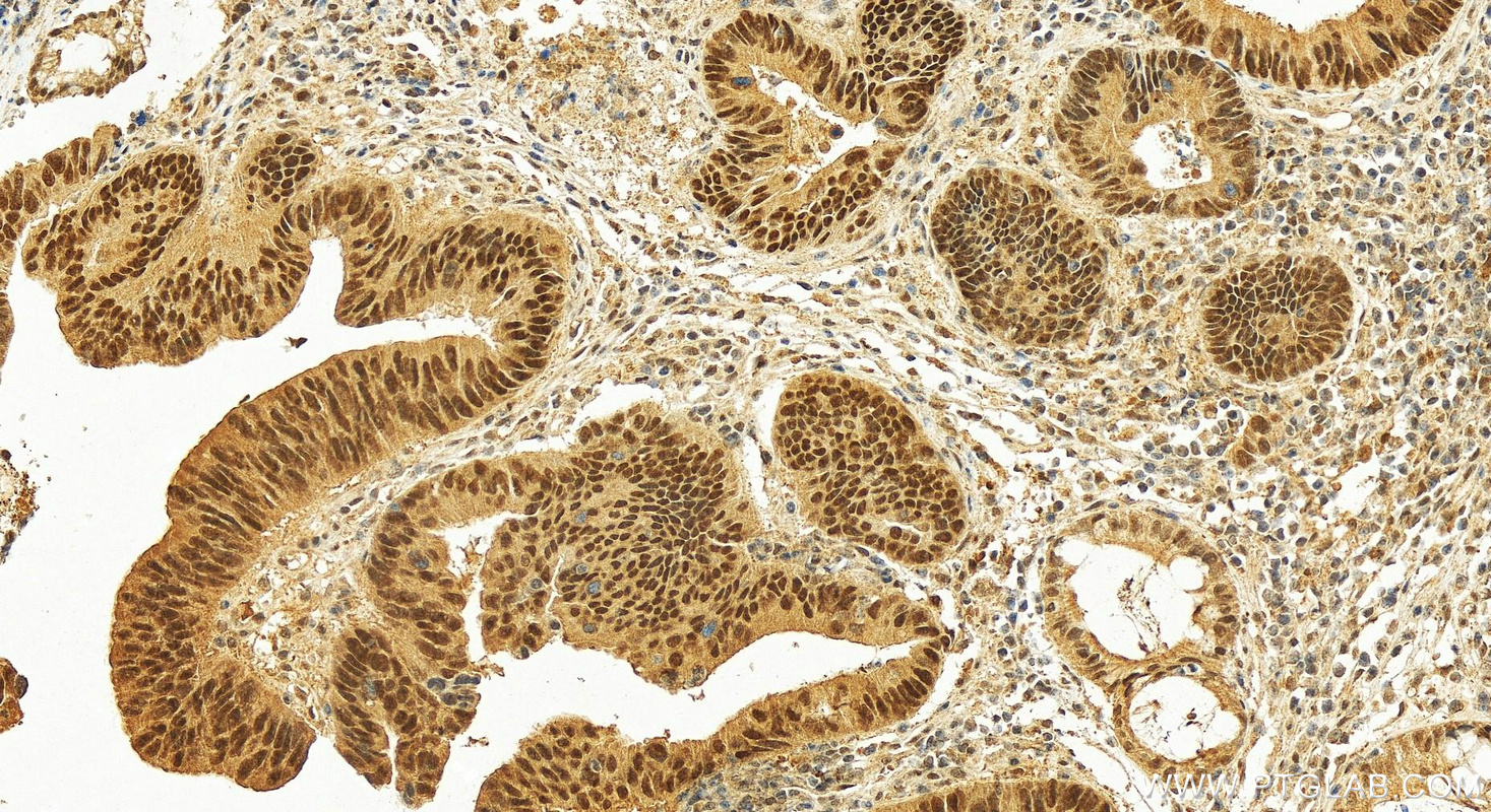 IHC staining of human colon cancer using 27266-1-AP